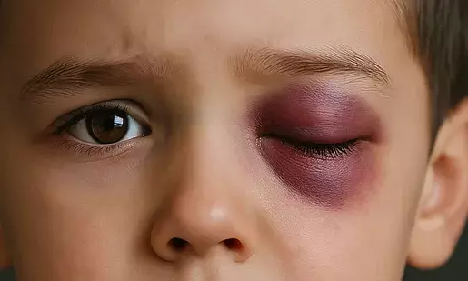 Six-year-old boy loses eye after teacher’s alleged act in Karnataka school, booked